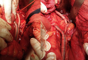Primer tiempo quirúrgico. Transposición de vasos viscerales. A) Anastomosis de la ilíaca externa izquierda al cuerpo principal del injerto. B) Anastomosis de la rama derecha del injerto a la arteria esplénica. C) Anastomosis de la rama izquierda a la arteria mesentérica superior. D) Anastomosis de la rama izquierda del injerto protésico a la arteria renal izquierda.