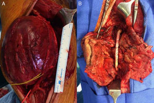 Imágenes intraoperatorias donde se observa: A) Aneurisma de AFS y 1.ª porción de poplítea con el nervio tibial referenciado (vessel-loop amarillo) y B) Imagen de bypass protésico de PTFE tras la resección del aneurisma.