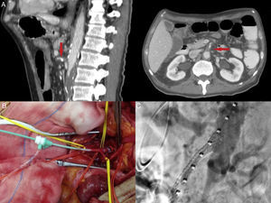 A) Angio-TC diagnóstico que muestra trombosis de la arteria mesentérica superior, desde su origen en un corte sagital y transversal (flecha). B) Imagen intraoperatoria. La AMS se encuentra disecada y controlada aproximadamente a 5cm de su origen, canalizada por un introductor por vía retrógrada. C) Arteriografía de control intraoperatoria. Se observa la permeabilidad y el correcto posicionamiento del stent.