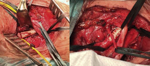 Resección de la costilla cervical y reparación de la arteria subclavia con una prótesis de politetrafluoroetileno anillada de 8mm correspondientes al primer caso.