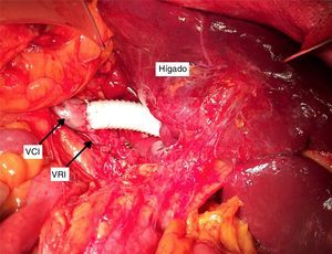 Campo operatorio: prótesis anillada de PTFE con anastomosis distal oblicua a vena cava inferior preservando el desagüe de la vena renal izquierda. VCI: vena cava inferior; VRI: vena renal izquierda.