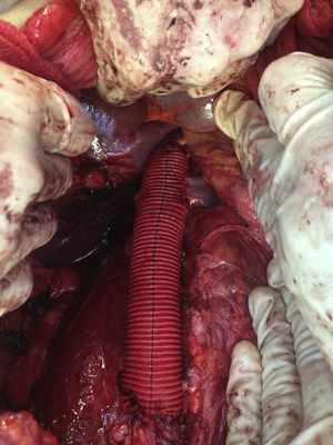 Imagen transoperatoria de injerto de dacrón y reimplante de vena renal izquierda.
