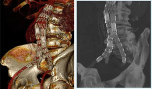 Imagen de dispositivo de ramas iliacas derecho de un paciente de la muestra. Reconstrucción 3D de la angio-TAC.