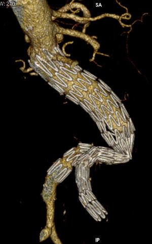 Se observa un caso de trombosis por migración craneal del sellado distal como consecuencia de la remodelación del saco aneurismático.