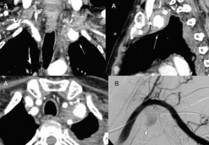 Detalle del seudoaneurisma de la arteria mamaria interna izquierda (flechas blancas) en: A) angio-TC cérvico-torácico diagnóstico. Detalle de cortes coronal, sagital y axial. B) Imagen angiográfica intraoperatoria.