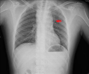 Radiografía postero-anterior de tórax que muestra ensanchamiento mediastinal (flecha).