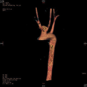 Reconstrucción en 3D de la angiotomografía de tórax. Seudoaneurisma en el origen común del tronco braquicefálico y la arteria carótida izquierda, en contexto de un arco aórtico bovino (A). Tronco braquiocefálico (B). Carótida izquierda (C).