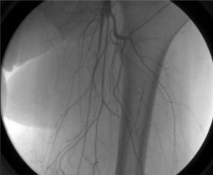 Angiografía inicial: estenosis severa de las arterias femorales superficial y profunda con presencia de vasos colaterales.
