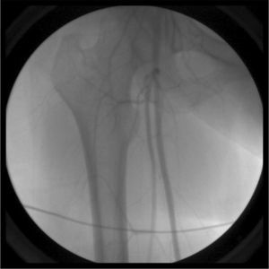 Después del tratamiento vasodilatador, la angiografía demostró que el espasmo arterial había desaparecido. Se visualizan las arterias femoral superficial y profunda permeables.