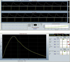 Imagen superior: curva del electrocardiograma durante la medición del AOP. Imagen inferior: curva de presión aórtica, valor del IA con la corrección IA@75.