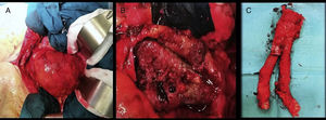 A) Laparotomía media con abordaje transperitoneal y exposición del aneurisma de 97 mm. B) Apertura del saco aneurismático con visualización de la endoprótesis. C) Endoprótesis explantada.
