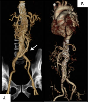 A y B) Las imágenes corresponden a la reconstrucción en 3D del angio-TC de control postoperatorio donde se observa el bypass desde la arteria ilíaca común derecha a AMS y a bypass aorto-renal previo y la endoprótesis de aorta torácica Valiant Captivia®.