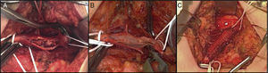 Arteria femoral común: A) Arteriotomía con abundantes placas de colesterol. B) Endarterectomía+profundoplastia. C) Cierre con parche de Dacron®.