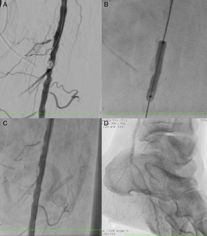 Angiografía: A) Estenosis crítica de la arteria femoral superficial. B) Angioplastia con balón. C) Angioplastia con stent autoexpandible. D) Control con buen flujo de la arteria tibial posterior y plantar.