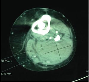 CT de falso aneurisma tras prótesis total de rodilla.