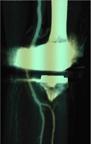 Control postoperatorio de bypass poplíteo-poplíteo tras prótesis total de rodilla.