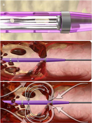 Sistema AngioJet® Ultra. a) Flujo salino en el interior del catéter. b) Visualización del catéter en acción intravaso. c) Vórtice de flujo aspirativo.