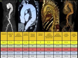 Características anatómicas de los aneurismas de aorta torácica descendente en las 4 pacientes al diagnóstico.