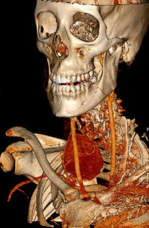 Seudoaneurisma de la arteria vertebral derecha de 5,3cm de diámetro máximo.