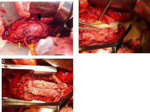 A) Aneurisma de aorta infrarrenal (flecha negra) tras laparotomía media e identificación de arteria mesentérica inferior (flecha amarilla). B) Aortotomía y exudado purulento. C) Exposición de endoprótesis infectada.