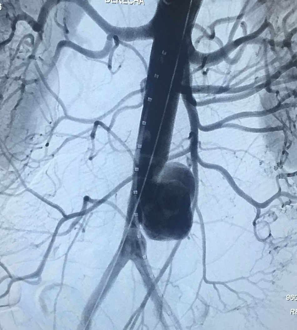 Tratamiento endovascular de aneurismas micóticos de aorta: reporte de ...