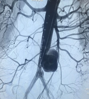 Angiografía que revela aneurisma micótico de aorta infrarrenal.