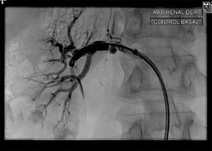 Angiografía de arteria renal derecha que evidencia 2 estenosis críticas en el tercio medio con una porción intermedia con cierta dilatación aneurismática, hallazgos compatibles con displasia fibromuscular.