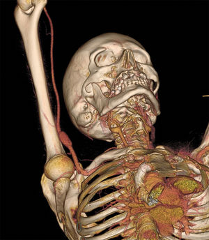 Reconstrucción de la tomografía computarizada de aorta torácica y troncos supraaórticos preoperatoria. Se aprecia aneurisma fusiforme a nivel de la arteria axilar derecha.