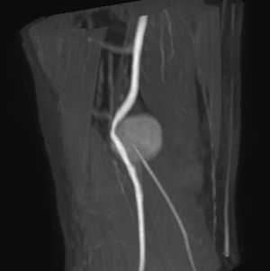 Resonancia magnética de miembro inferior derecho: Masa de 40mm en fosa poplítea que condiciona la desviación arterial.