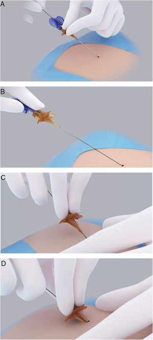 Secuencias instrucciones de uso de Cutneedle®: A) Punción convencional del vaso con introducción de guía. B) Liberación de la pieza dilatadora mediante presión de la base de la aguja donde existe la pieza en forma de clip. C) Sujeción y deslizamiento de la pieza sobre la guía hasta llegar a la piel. D) Introducción de la pieza en el tejido subcutáneo ejerciendo una moderada presión siguiendo la misma dirección de guía.