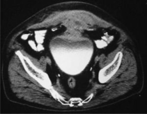 Tomografía computarizada abdominopelviana, infiltración de la cara posterior de los músculos rectos anteriores del abdomen.