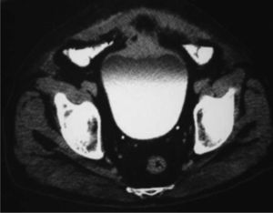 Tomografía computarizada abdominopelviana, infiltración tumoral de la cúpula vesical.