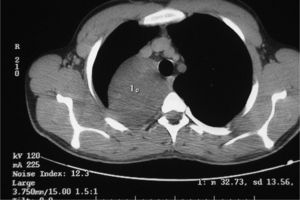 Imagen de la tomografía computarizada donde se observa la supuesta metástasis pulmonar, aunque posteriormente se confirmó que se trataba de un ganglioneuroma.