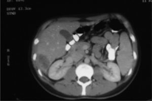 Imagen de la tomografía computarizada donde se observa metástasis hepática en el segmento VI tras ciclo de quimioterapia, previamente a la cirugía.