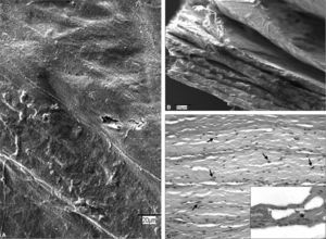 Surgisis®. A: imagen al microscopio electrónico de barrido de la superficie protésica (×20). B: sección transversal en la que puede apreciarse el espesor del biomaterial y las capas laminares que lo conforman (×200). C: detalle al microscopio óptico (HE, ×200) de un corte transversal, en el que son claramente visibles núcleos celulares (flechas) entre las fibras de colágeno y vasos sanguíneos contenido hemático (asterisco). Recuadro inferior derecho: tricrómico de Masson(×630).