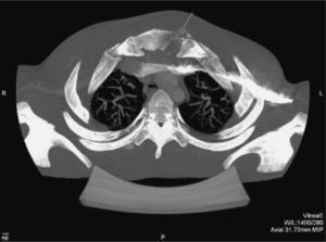 Tomografía computarizada torácica: lesión lítica a nivel esternal, con absceso perilesional.