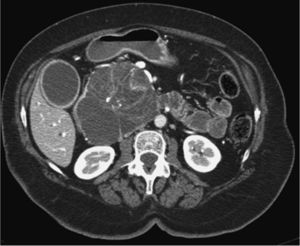 Cistadenoma seroso en cabeza de páncreas. Tomografía computarizada abdominal que muestra una imagen típica “en estrella”, microquistes y calcificaciones centrales.