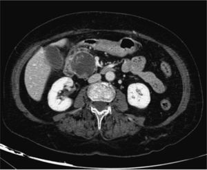 Tomografía computarizada abdominal que muestra lesión macroquística, con septos en su interior, localizada en cabeza pancreática, correspondiente a un cistadenoma mucinoso.