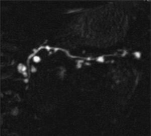 Colangiorresonancia magnética que muestra una NIPM de ramas secundarias, con afección difusa de toda la glándula.