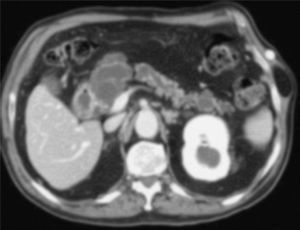 Tomografía computarizada abdominal que muestra dilatación difusa del ducto pancreático e indica NIPM de rama principal.