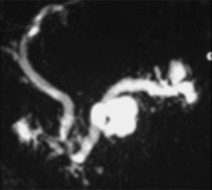 Colangiorresonancia magnética que muestra dilatación difusa del ducto pancreático y de ramas secundarias e indica NIPM de tipo mixto.