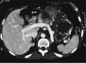 Tomografía computarizada abdominal que muestra lesión con componente sólido y quístico y múltiples calcificaciones, correspondiente a tumor sólido seudopapilar en cuerpo y cola de páncreas.