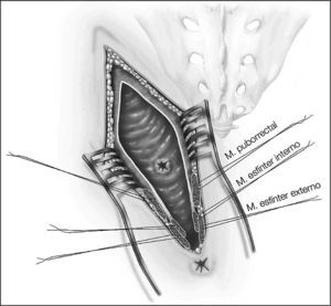 Exposición transrrectal transesfinteriana posterior del trayecto fistuloso localizado en la cara anterior del recto.