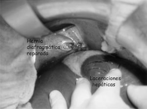 Hernia diafragmática reparada con puntos sueltos de polipropileno. Lesiones transversas en el parénquima hepático producidas por el tubo de tórax. Se ha aplicado una capa de fibrinógeno y trombina humana, para controlar la hemostasia y aislar la sutura de polipropileno del parénquima hepático dañado.