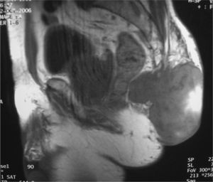 Resonancia magnética pelviana. Tumor presacro con infiltración de cóccix y S5.