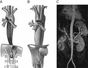 Esquema anatómico de los trayectos posibles de la aorta en relación con el orificio hiatal. A: trayecto más habitual próximo al pilar derecho. B: trayecto más anterior próximo al pilar izquierdo. C: resonancia magnética aórtica postoperatoria del paciente.
