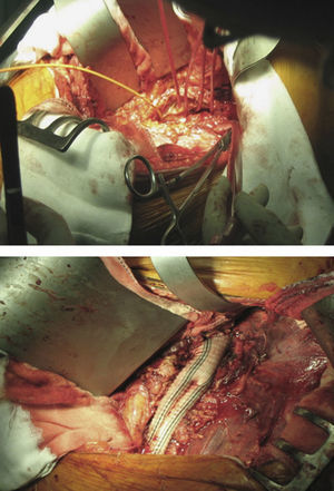 Sistema de perfusión multirrama y resultado quirúrgico final con bypass aortoilíaco derecho y aortofemoral izquierdo.