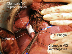 Exclusión vascular hepática total con pinzamiento de vena cava inferior (VCI).