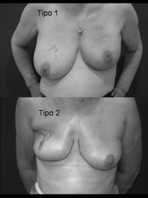 Secuelas de cirugía conservadora del cáncer de mama tipo 1 y 2 según la clasificación de Clough.