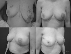 Asimetría mamaria, secuela de cirugía conservadora de cáncer de mama, tratada mediante reducción de la mama contralateral.